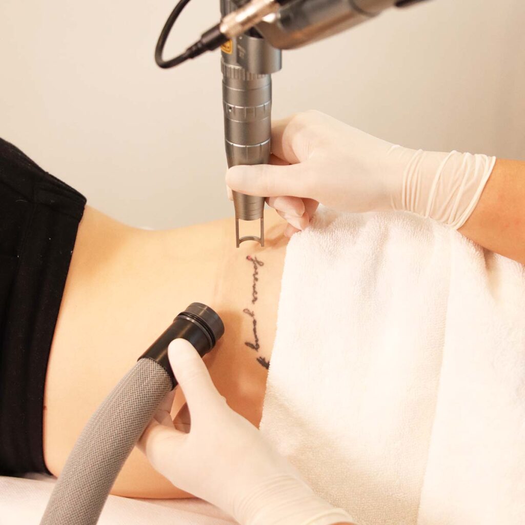 The history of tattoo removal. Here's how we went from salt to lasers.