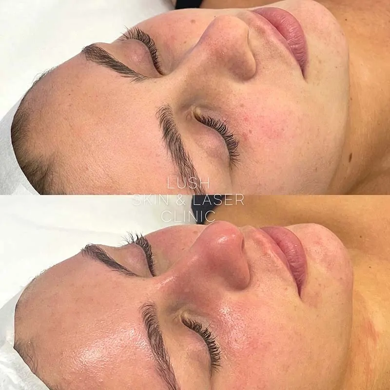 lush skin and laser clinic before and after 1
