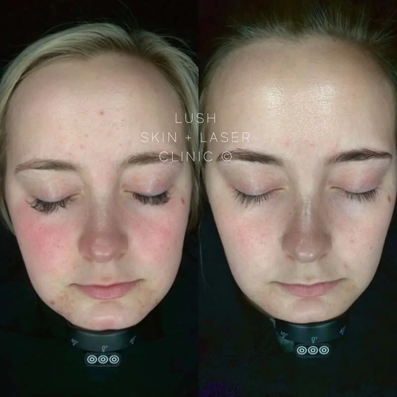 lush skin and laser clinic before and after 10