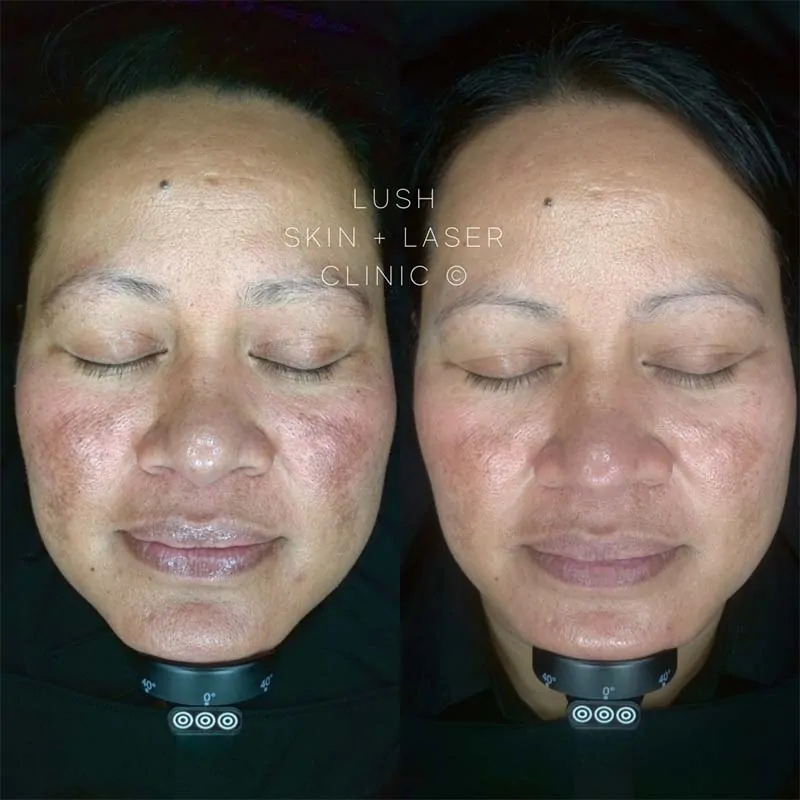 lush skin and laser clinic before and after 11