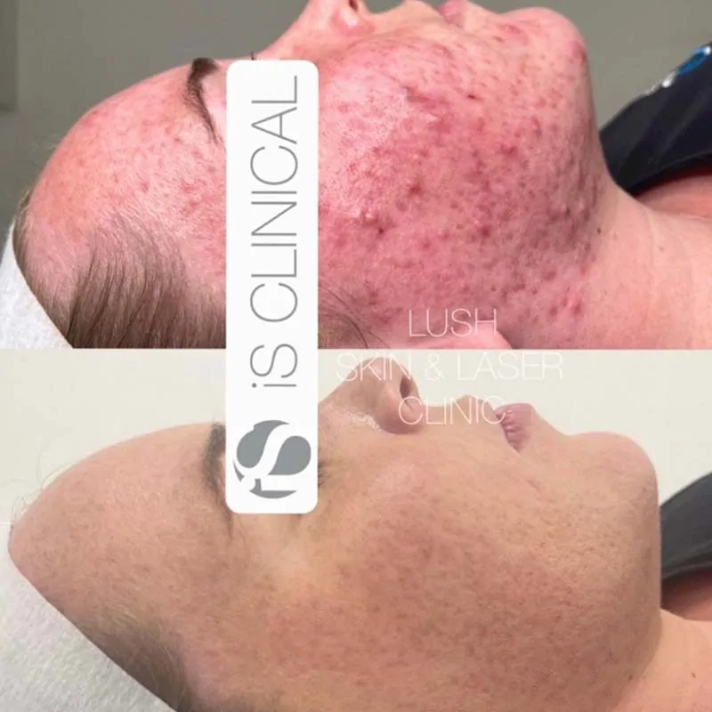 lush skin and laser clinic before and after 12