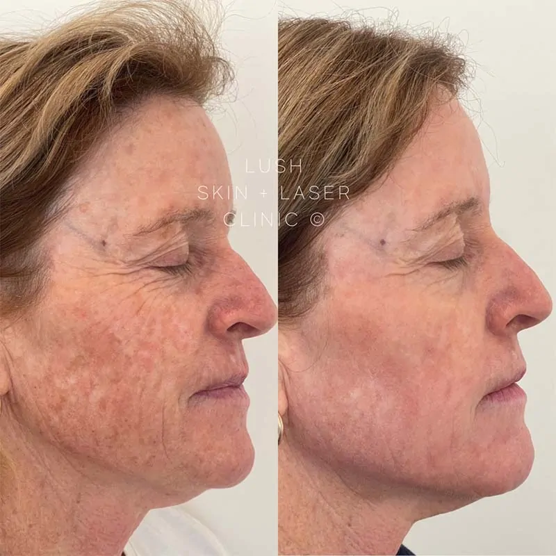 lush skin and laser clinic before and after 13