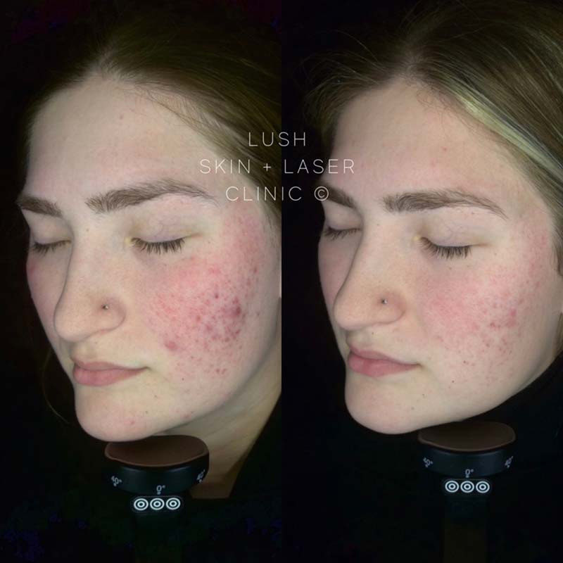lush skin and laser clinic before and after 14