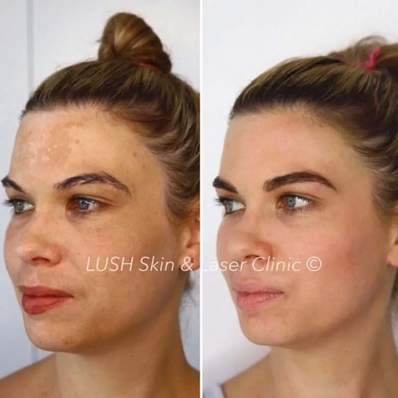 lush skin and laser clinic before and after 15