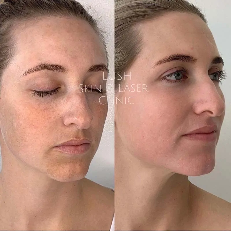 lush skin and laser clinic before and after 17