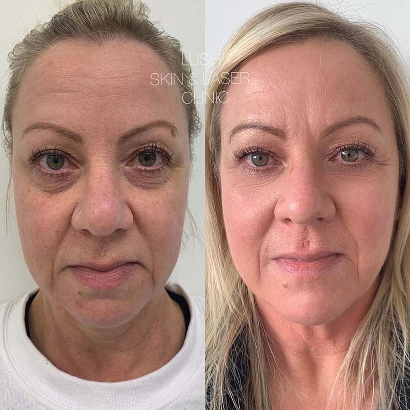 lush skin and laser clinic before and after 18
