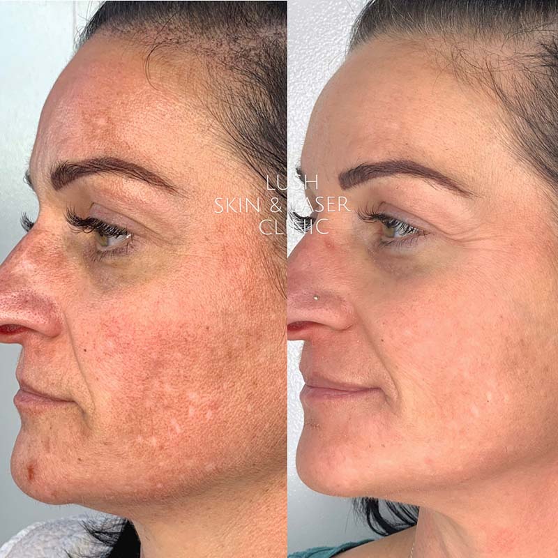 lush skin and laser clinic before and after 19