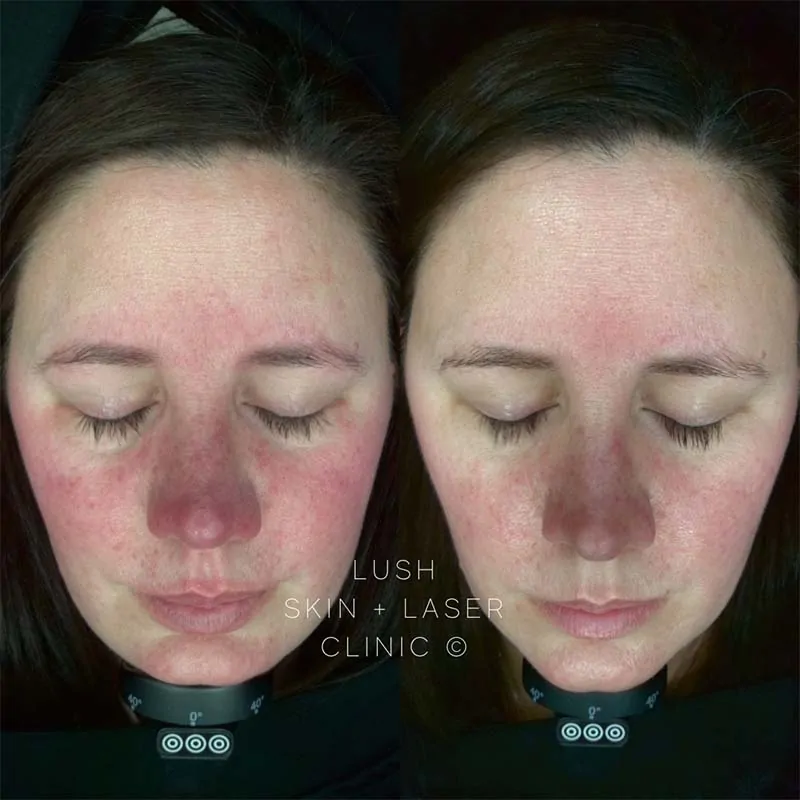 lush skin and laser clinic before and after 2