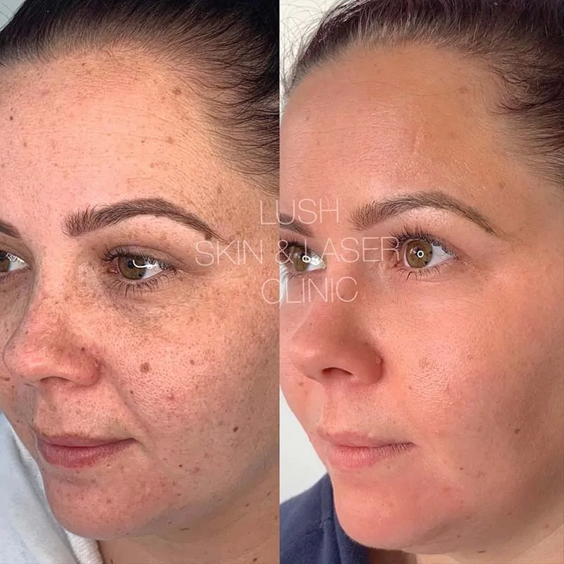 lush skin and laser clinic before and after 20