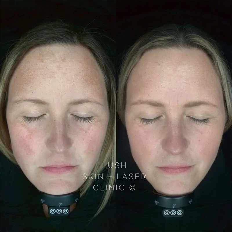 lush skin and laser clinic before and after 21