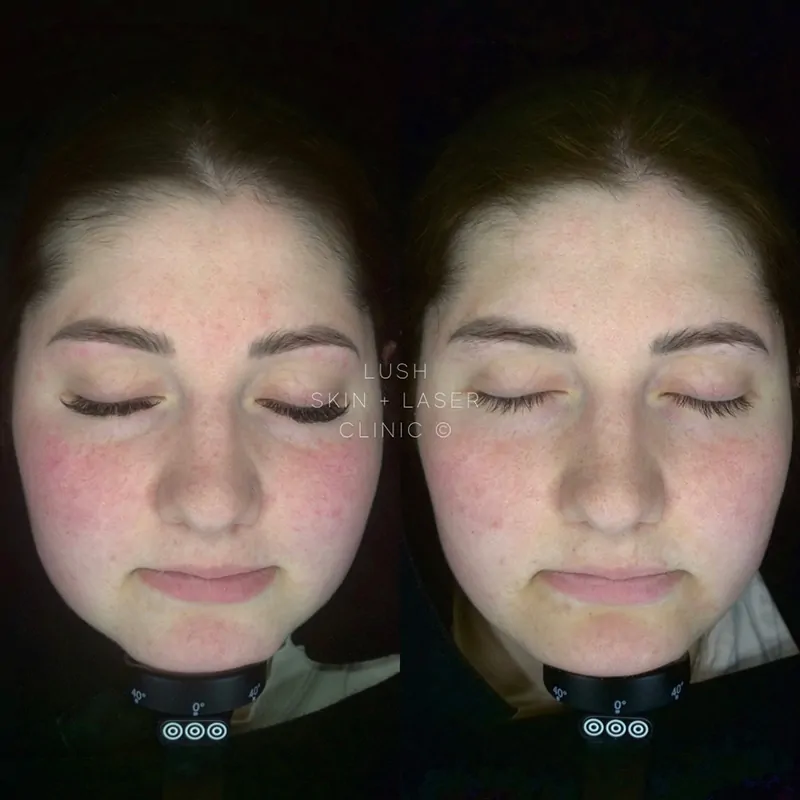 lush skin and laser clinic before and after 22