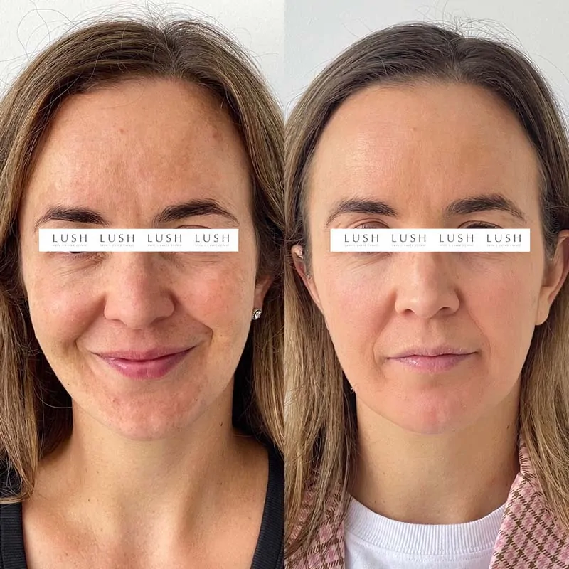 lush skin and laser clinic before and after 23
