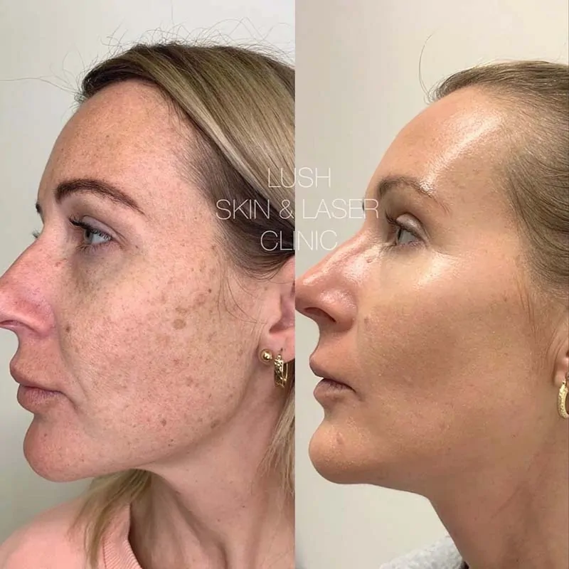lush skin and laser clinic before and after 24