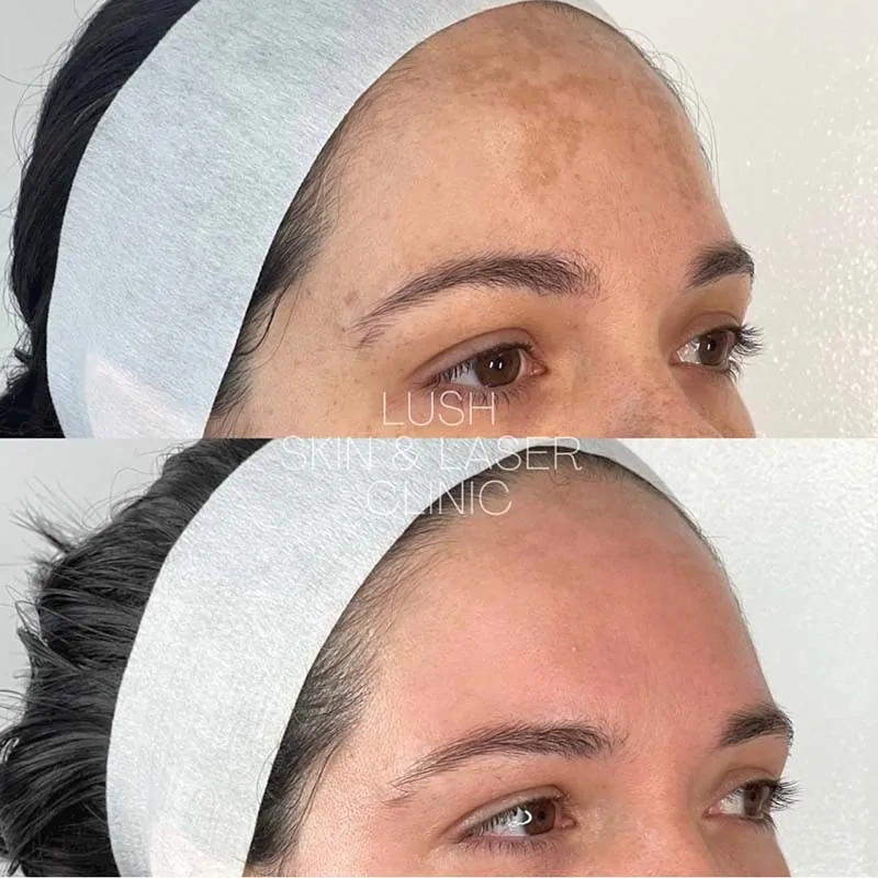 lush skin and laser clinic before and after 25