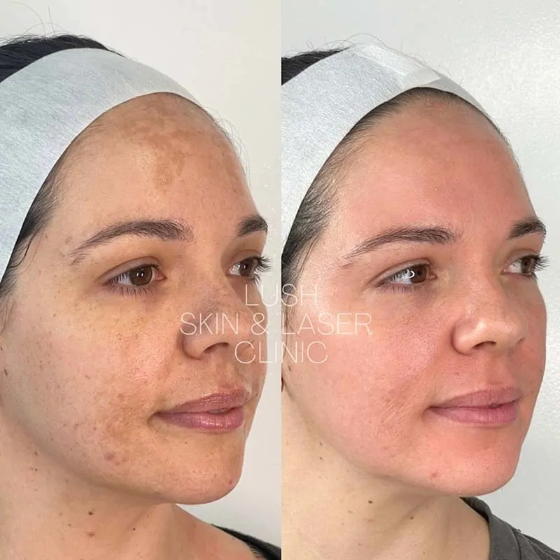 lush skin and laser clinic before and after 26