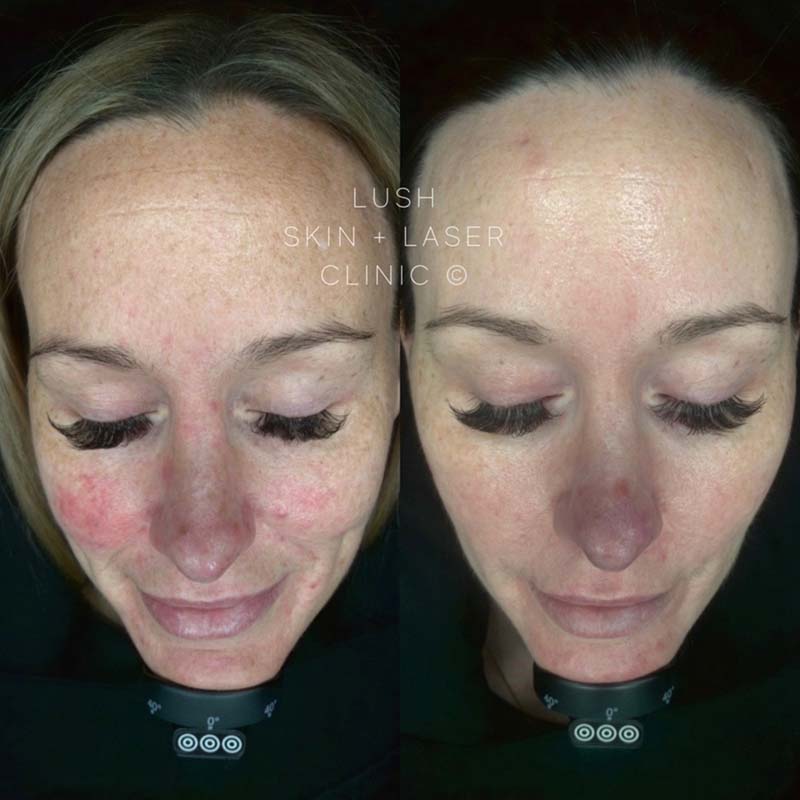 lush skin and laser clinic before and after 3