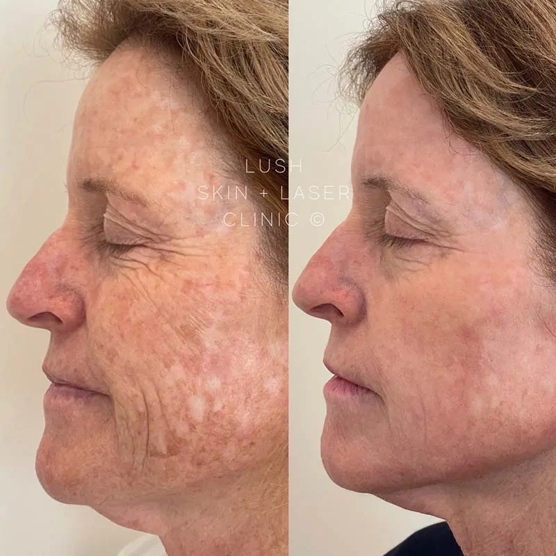 lush skin and laser clinic before and after 4