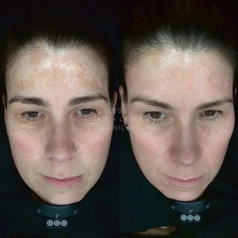 lush skin and laser clinic before and after 5