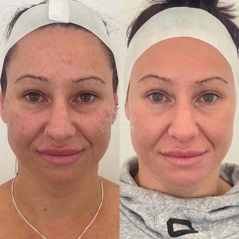 lush skin and laser clinic before and after 6