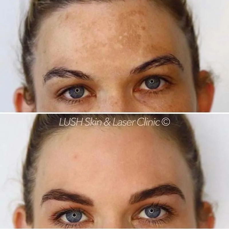 lush skin and laser clinic before and after 7