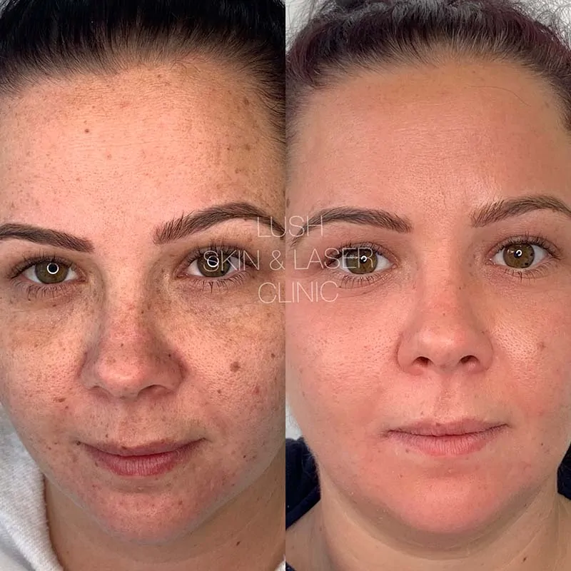 lush skin and laser clinic before and after 8