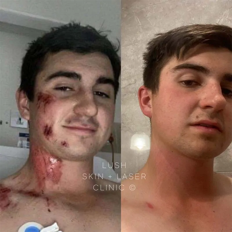 lush skin and laser clinic before and after 9