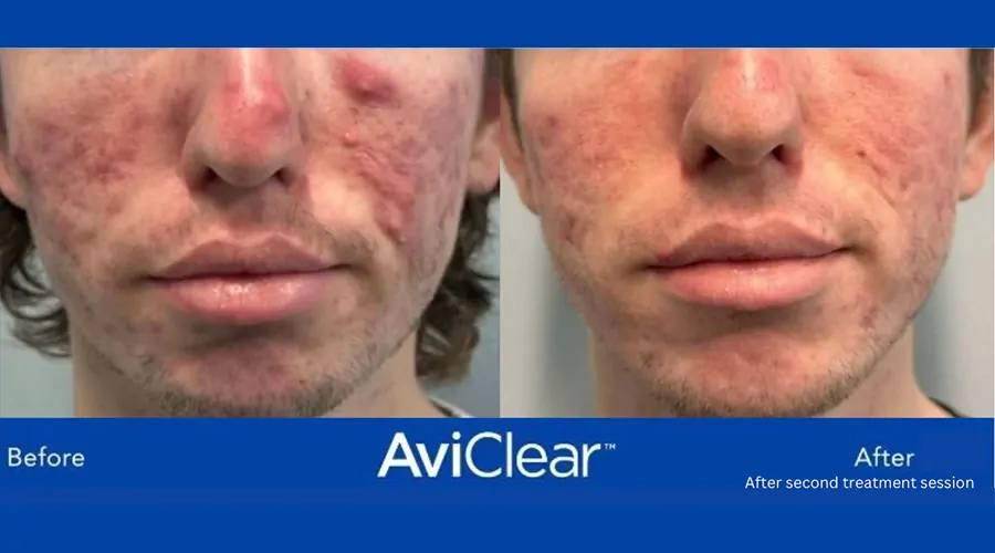 aviclear ba shepparton acne treatment 1 aviclear ba shepparton acne treatment 1
