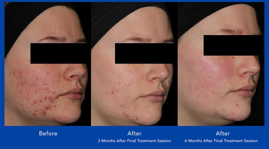 aviclear ba shepparton acne treatment 4