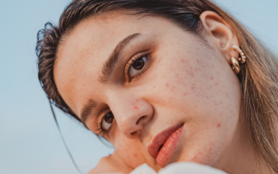 AviClear Laser Treatment: The Solution for Mums Worried About Their Teen’s Acne