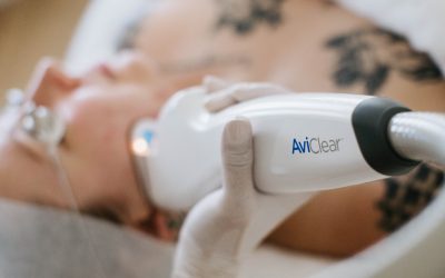 The Science Behind AviClear: Why This Acne Laser Treatment Stands Out