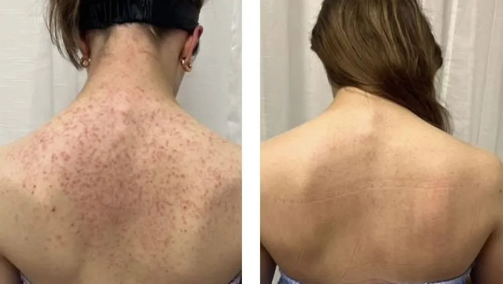Acne Laser Treatment before and after photo