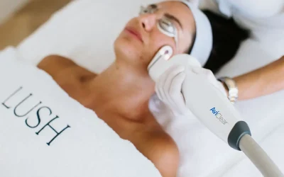 Acne Laser Treatment Explained: Benefits, Process, and Results
