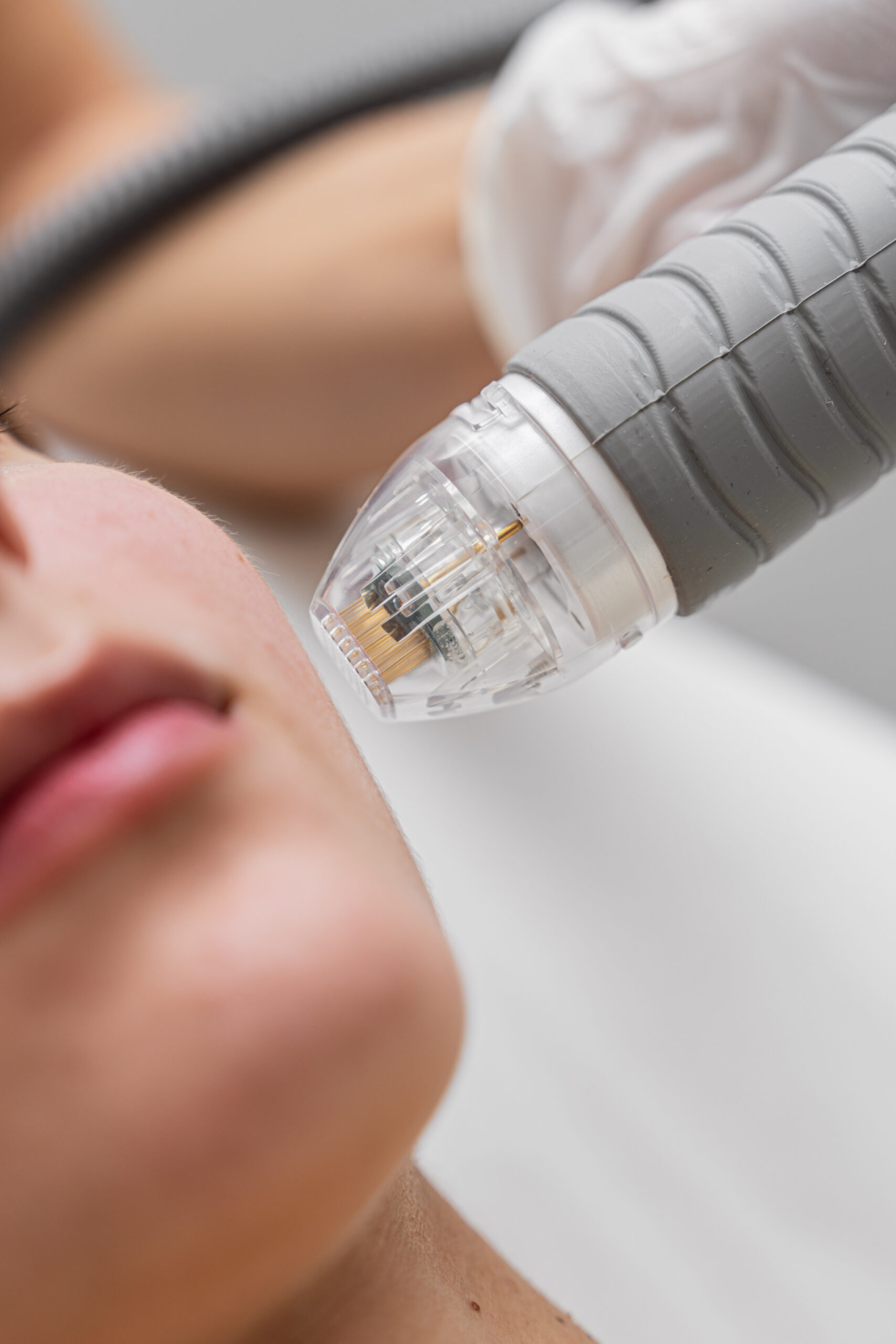 microneedle rf lifting procedure. hardware cosmetology.