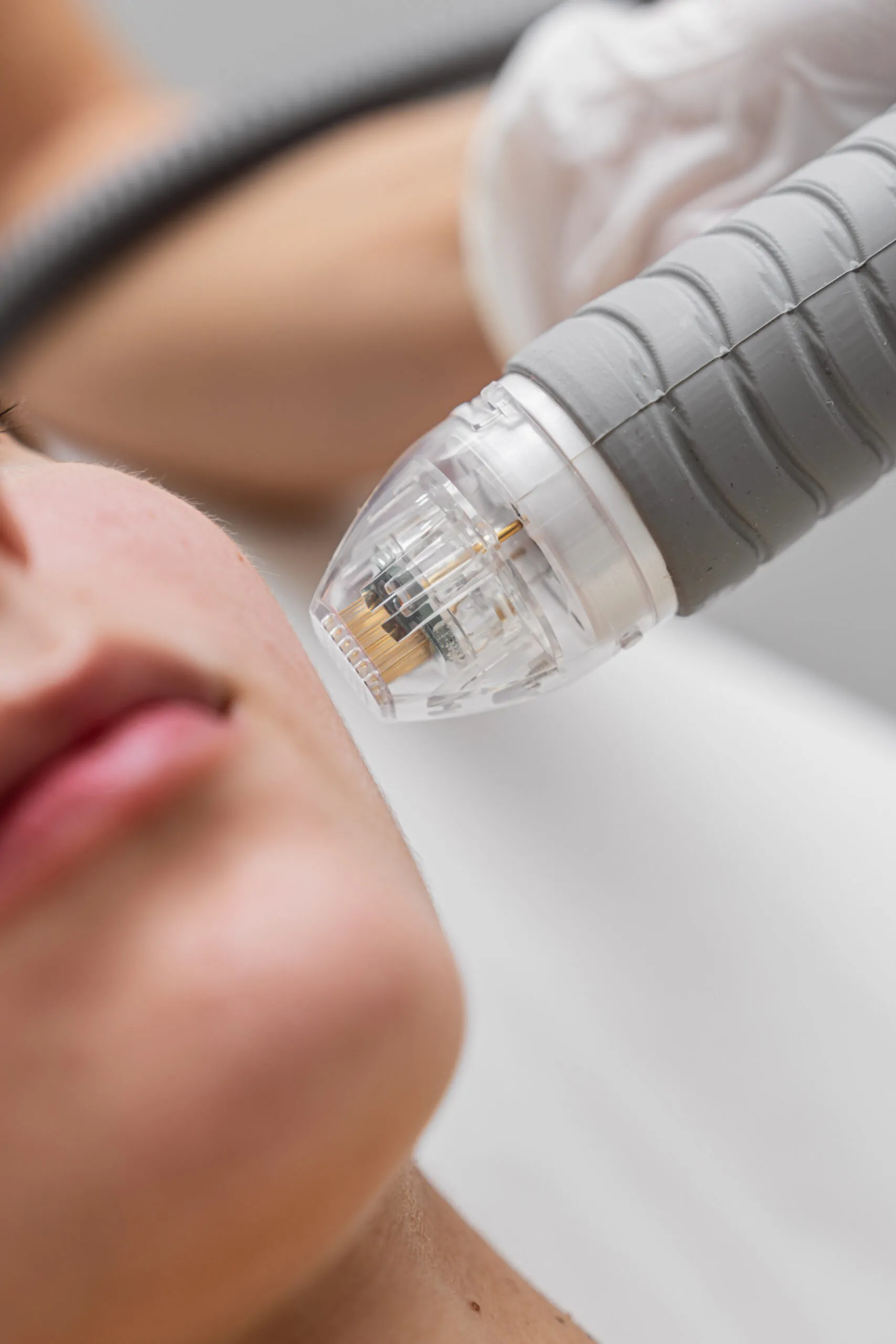 microneedle rf lifting procedure. hardware cosmetology.